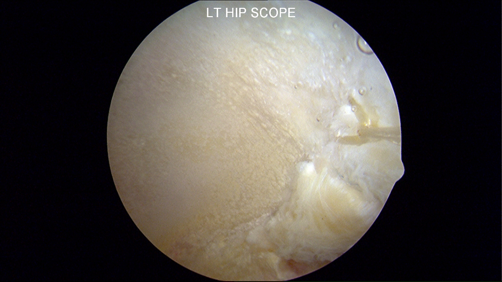 Restoring labral continuity