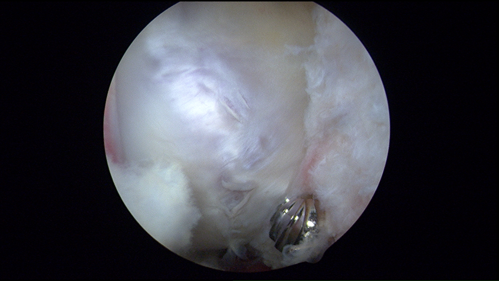 Secondary signs of femoroacetabular impingement in a young female athlete. The discoloration at the margin of the head and neck junction marks the area of abnormal contact. These changes are not well appreciated on imaging studies. A femoral head and neck osteoplasty was performed in this patient.