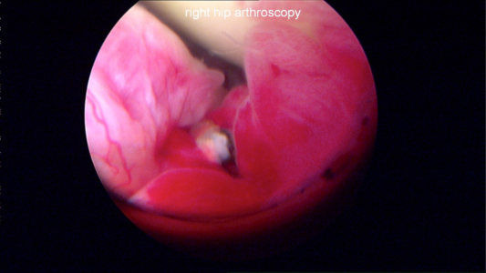 Severe synovitis in young male with extensive hip damage