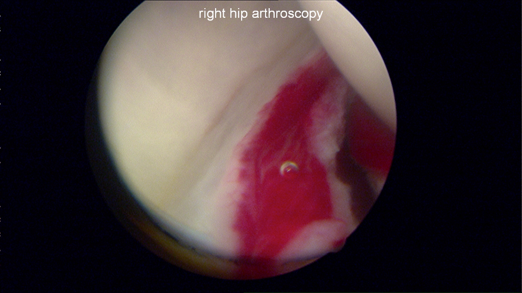 Severe synovitis of the hip noted at the joint capsule