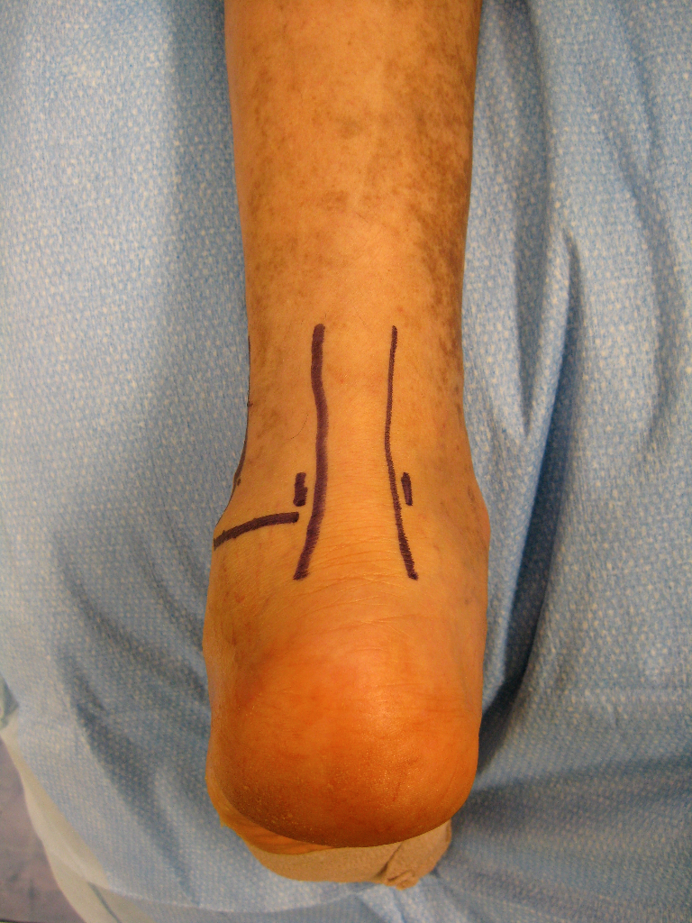 Small incisions for subtalar arthroscopy