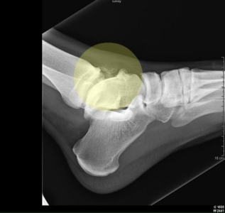 X-ray ankle anterior impingement and loose body X-ray: Anterior bone impingment and loose body removed with arthroscopy