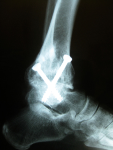 X-ray of ankle after arthroscopic fusion