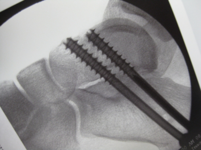 X-ray of screws placed for subtalar fusion completed with arthroscopy