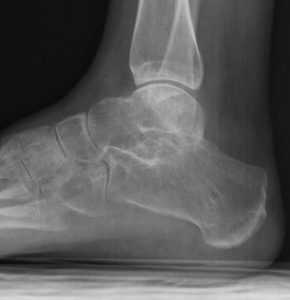 X-rays after healed subtalar fusion performed arthroscopically