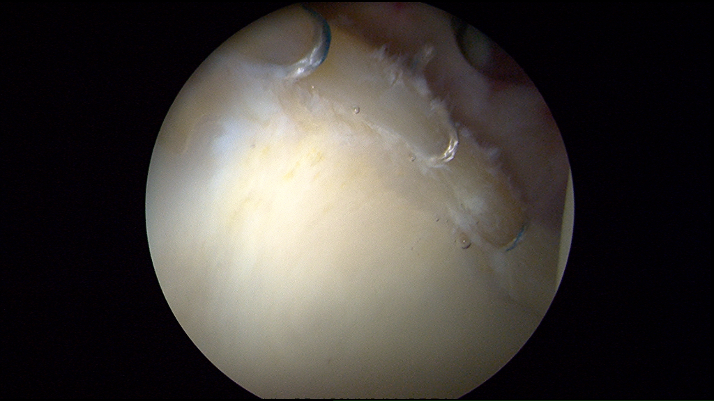Picture 2 of 3:  The same patient after rim trimming and labral repair.  In this case, the area of articular cartilage damage (localized arthritis) was removed prior to labral repair