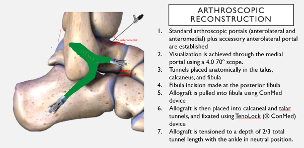 Ankle instability arthroscopic reconstruction