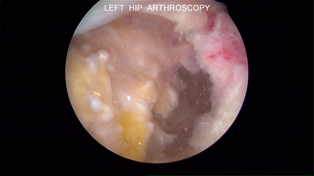 Extensive calcification in peripheral compartment: Ossification seen and removed at time of arthroscopy