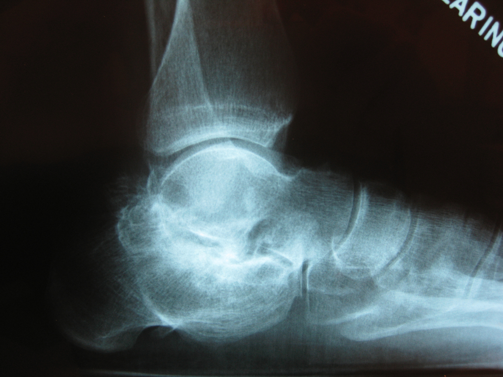 Subtalar joint arthritis after a calcaneus fracture.  This patient was treated with a subtalar fusion (arthrodesis) performed arthroscopically