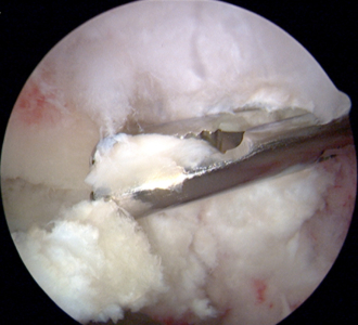 Hip loose body removal: Loose body of articular cartilage fragment removed at arthroscopy