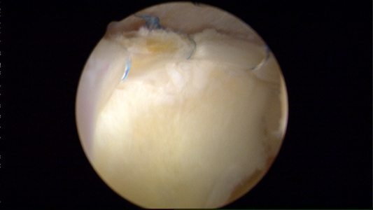 Example of 3 anchor repair of the labrum following a rim trimming and removal of small area of acetabular rim articular cartilage damage