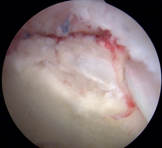 Labral repair with adjacent arthroscopy: labral repair with adjacent cartilage damage treated with labral repair and microfracture arthroscopy