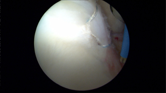 Posterior view of the same patient after rim trimming and labral repair.  In this case, the area of articular cartilage damage (localized arthritis) was removed prior to labral repair.