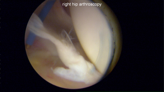 Ligamentum teres tear during hip arthroscopy