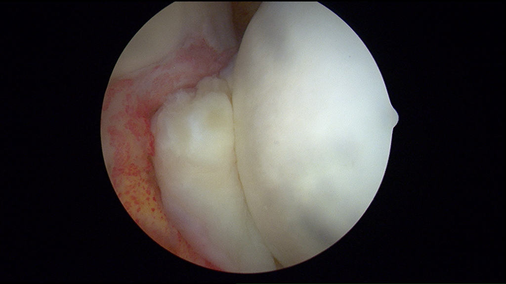 Ligamentum teres tear after treatment of fraying: Fraying and partial tearing of the ligamentum teres is noted in this patient at the time of hip arthroscopy