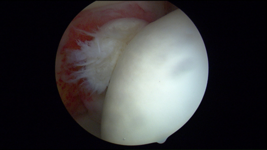 Ligamentum teres tear fraying: After treatment of the ligamentum teres during hip arthroscopy
