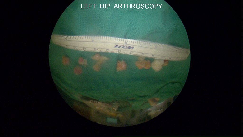 Major loose bodies removed: Loose bodies removed at time of arthroscopy
