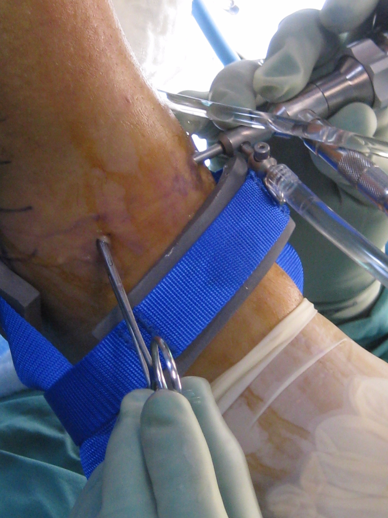 Ankle arthroscopy.  The nick and spread technique is demonstrated here.