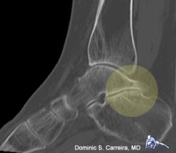 Posterior impingement after fracture