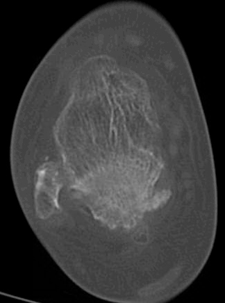 This image from a CT scan of the ankle demonstrates posterior impingement after a fracture.  This patient was treated with a posterior arthroscopic approach to remove the extra bone and release the FHL tendon