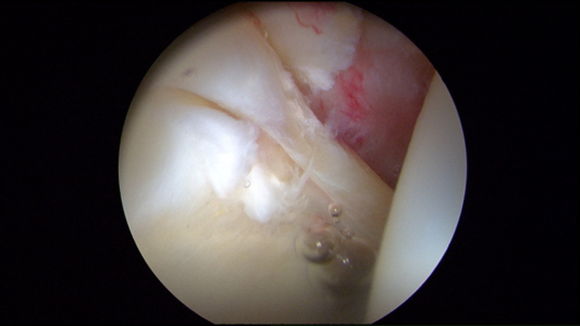Picture 1 of 3:  Labrum tear and adjacent area of rim articular cartilage damage in a middle-aged triathlete