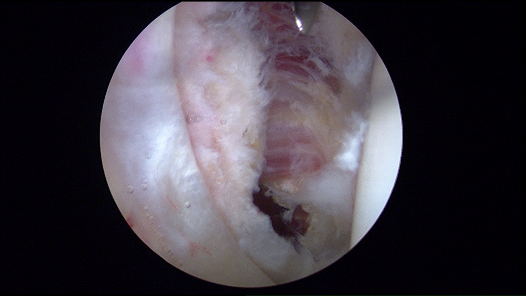 The edges of the cut psoas tendon are seen in this view during hip arthrosocpy.  The muscle fibers are noted in back of it and remain intact.