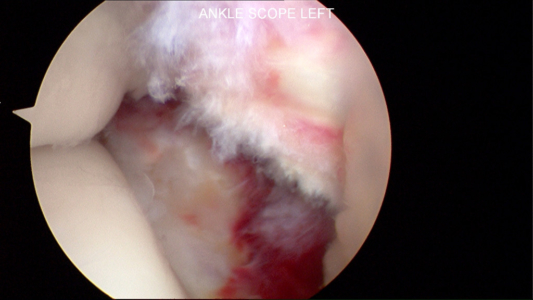 Joint reduced in anatomic position as viewed arthroscopically.  The fibula bone is well visualized in the bottom central and right portion of the screen.