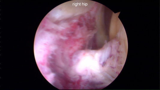 Synovitis of the hip from a septic joint infection. This was treated with a hip arthroscopy and with IV antibiotics.