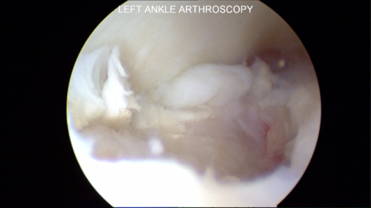 Talar dome defect: Defect of cartilage and bone following removal of loose osteochondral fragment