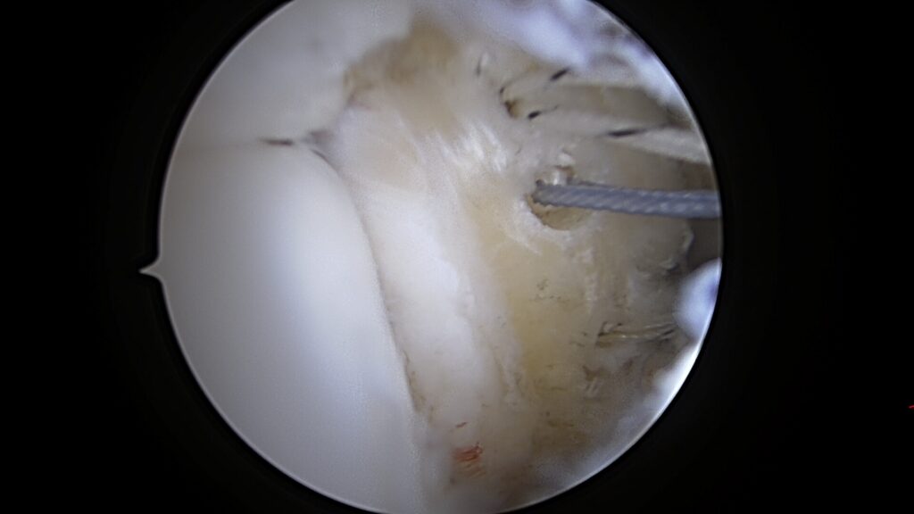 A three-anchor arthroscopic repair of ankle instability