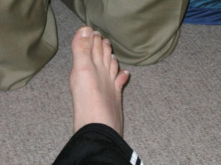 A toe fracture