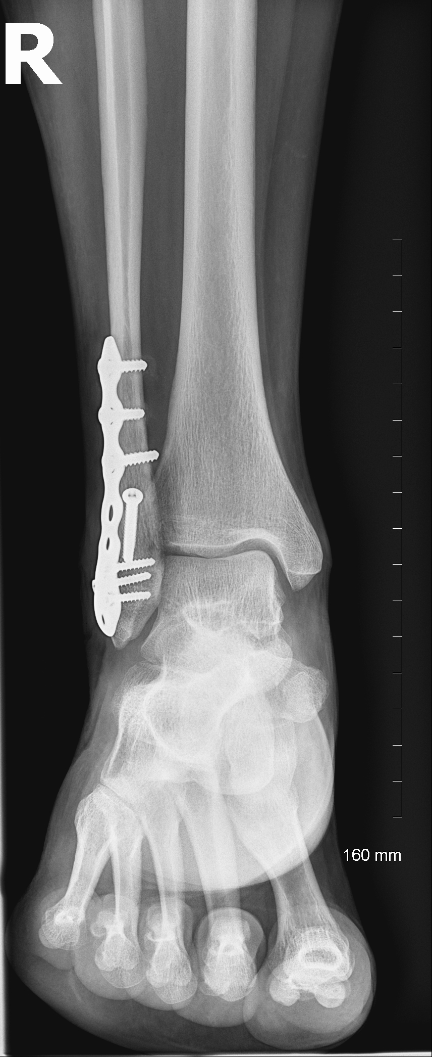 Ankle Fracture (After 01)