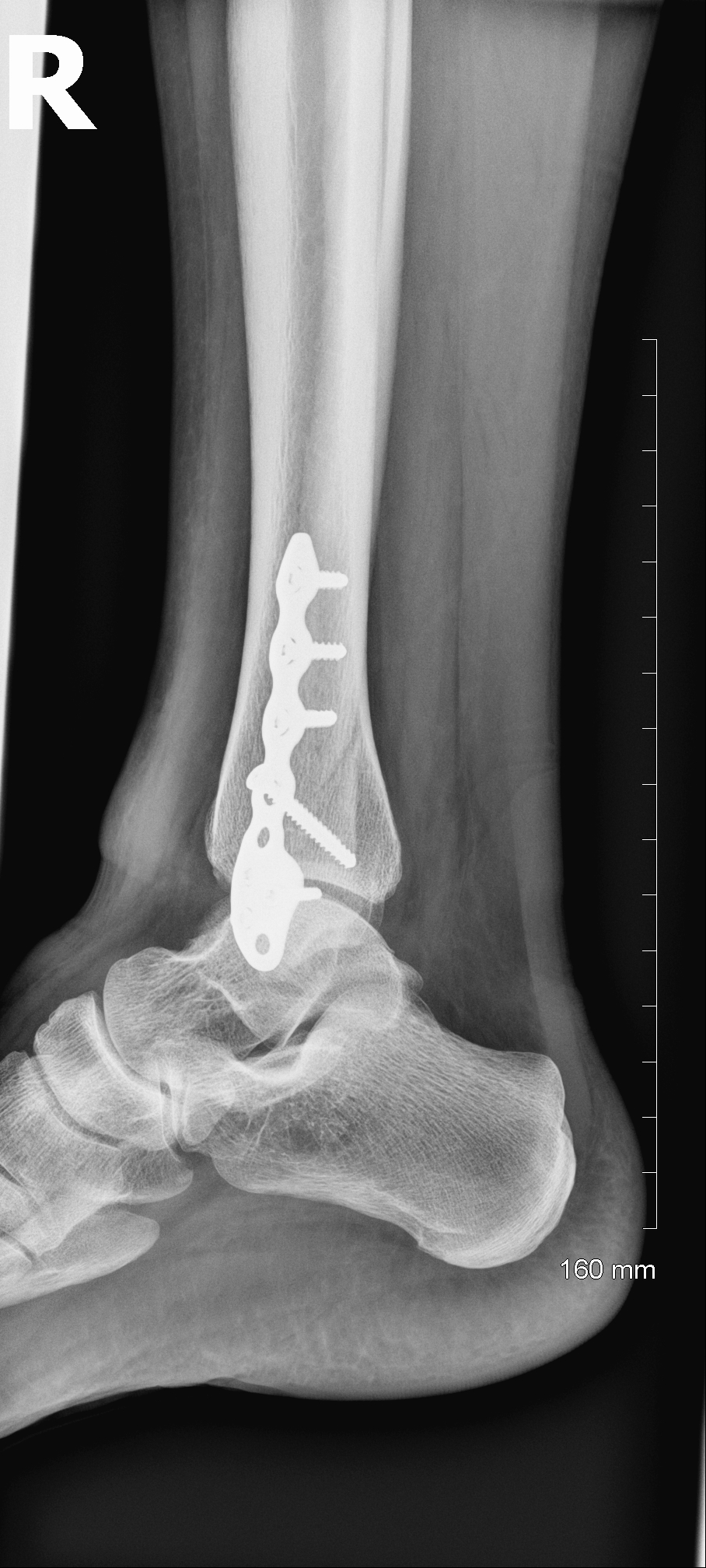 Ankle Fracture (After 03)