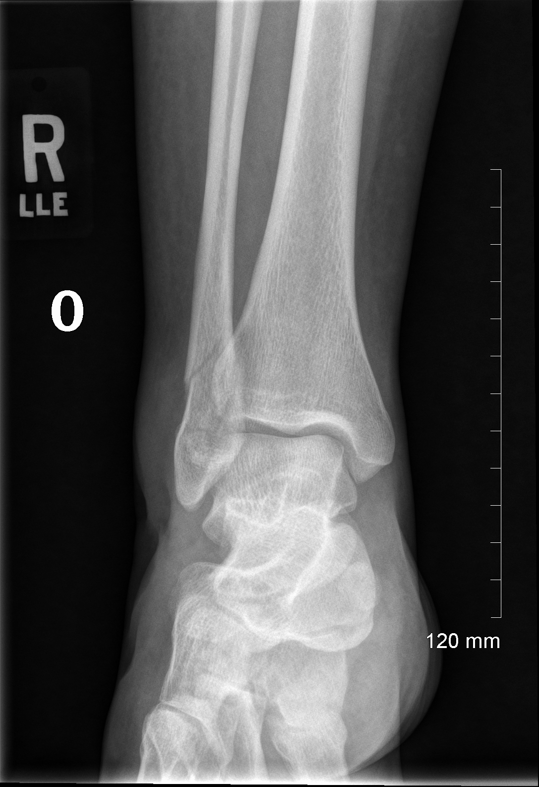 Ankle Fracture (Before 01)