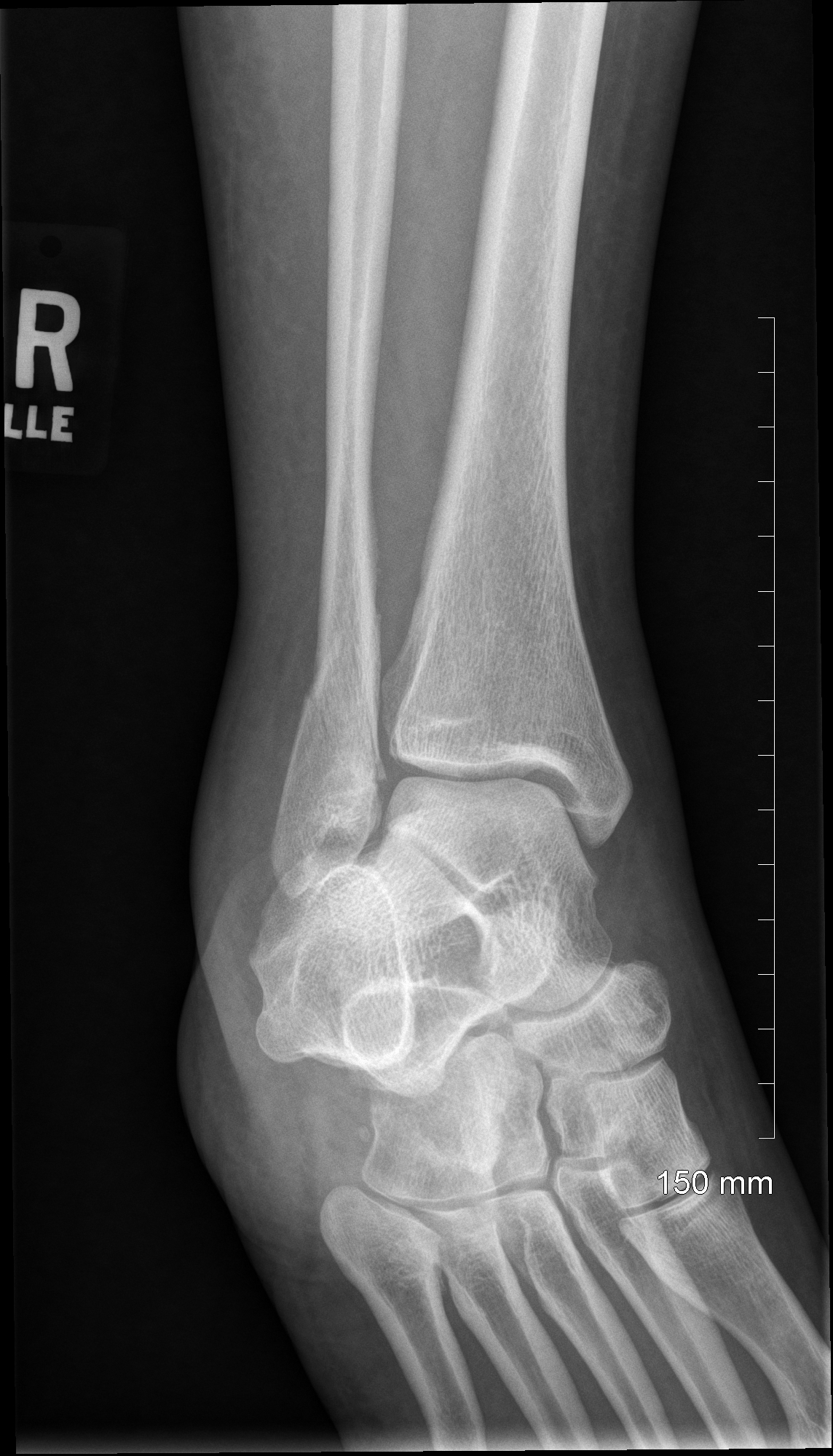 Ankle Fracture (Before 02)
