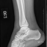Ankle Fracture (Before 03)