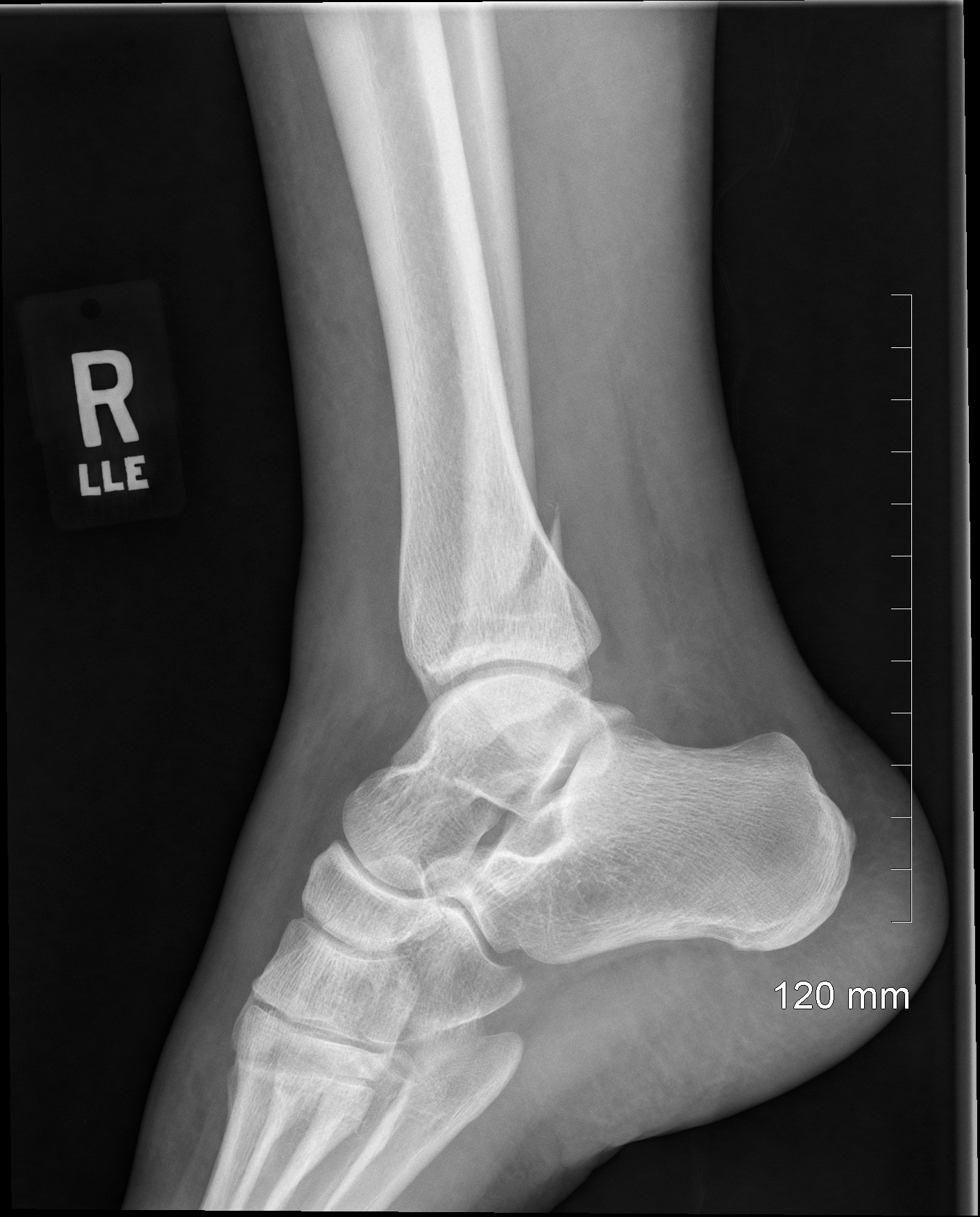 Ankle Fracture (Before 03)
