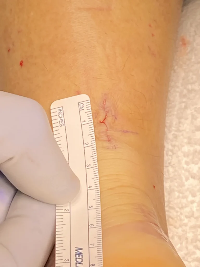 An incision for the mini open PAR Jig surgery to fix an Achilles tendon tear.