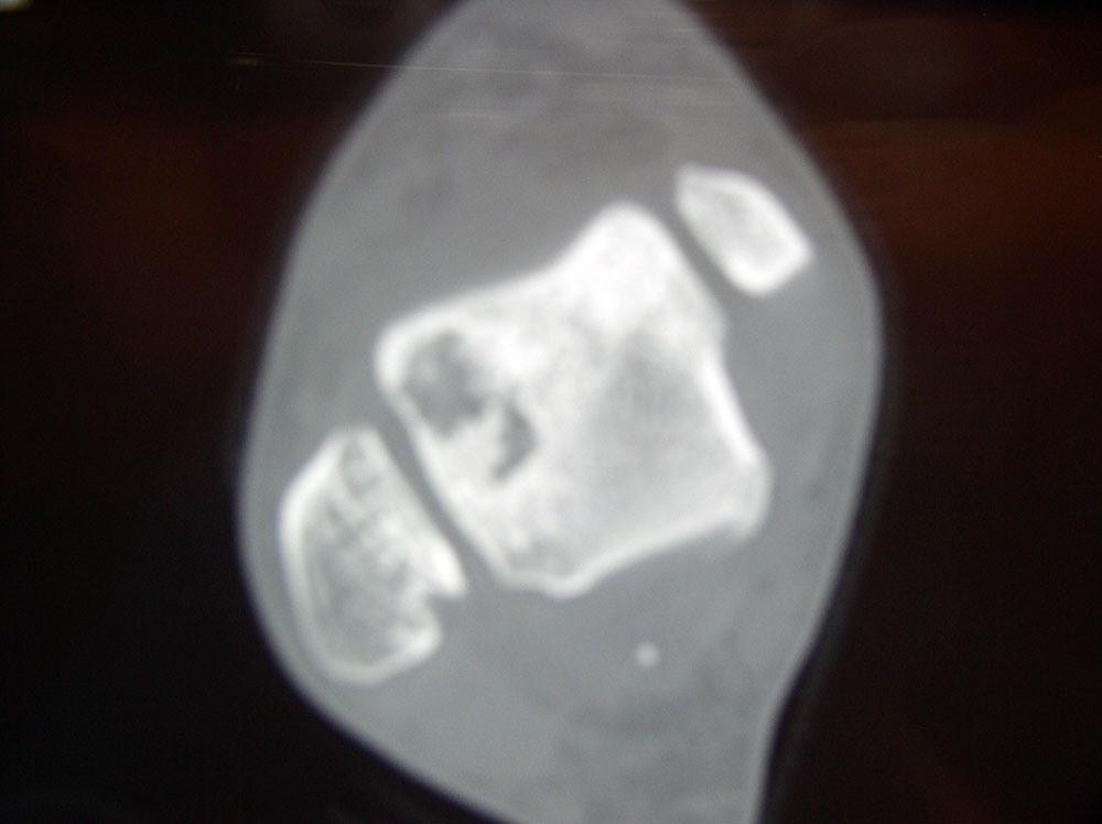 A CT-scan of an osteochondral defect of the talus (axial view)