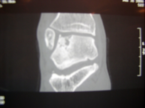 A CT-scan of an osteochondral defect of the talus (choronal view)