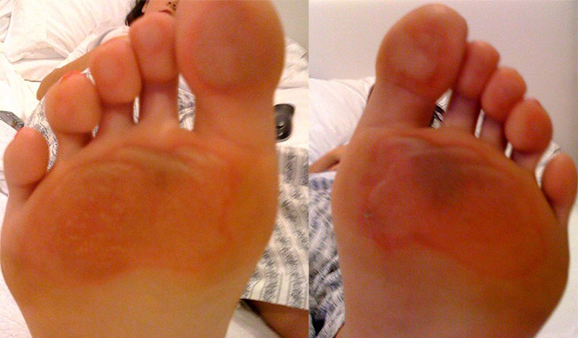 Burns on the bottom of the feet from running on asphalt barefoot in the South Florida heat