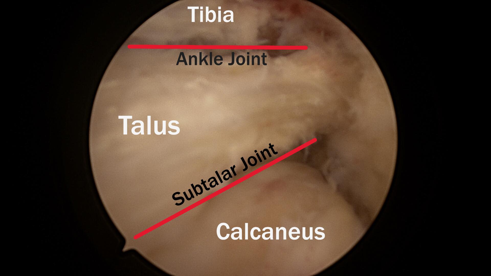 Arthroscopic view of the ankle and subtalar joints