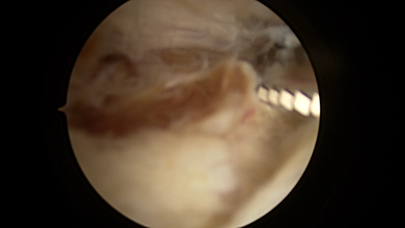 Posterior ankle joint line demonstrating the abnormal synovium in PVNS. 