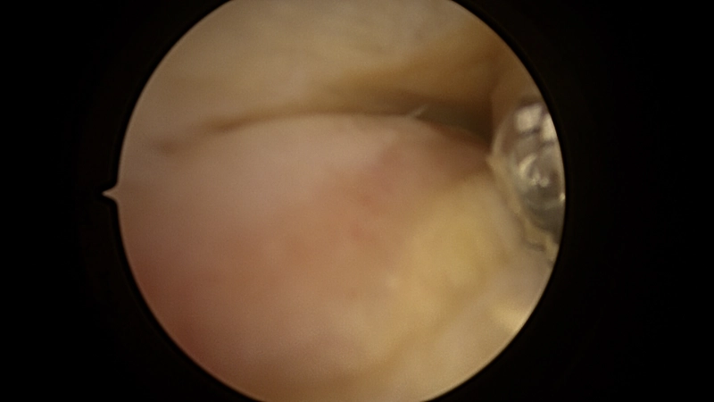 Posterior ankle joint line demonstrating the abnormal synovium in PVNS. 