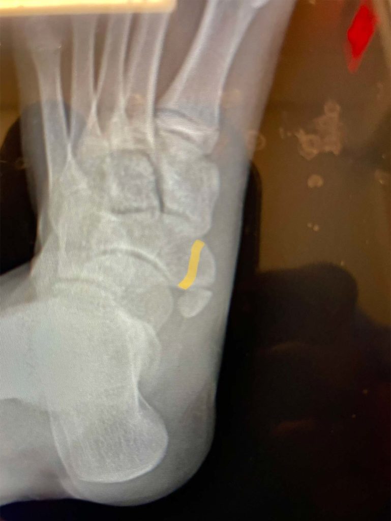 Os Navicular Accessory Bone Removal Dominic Carreira, MD Atlanta