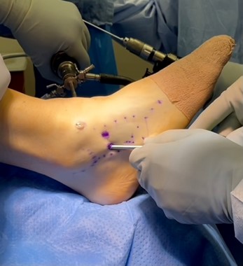 arthroscopic ankle surgery