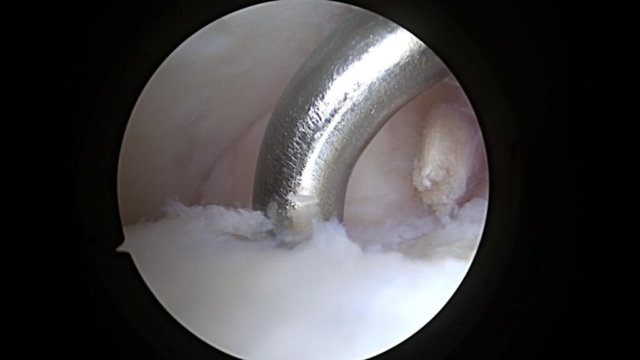After the flap of cartilage was removed, and a stable periphery to the cartilage defect was created, a microfracture awl as pictured here is used to poke multiple holes in the defect to stimulate cartilage healing.