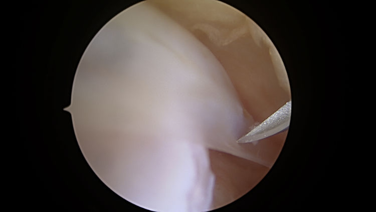 Plica (bands of synovial tissue) noted during a routine ankle arthroscopy