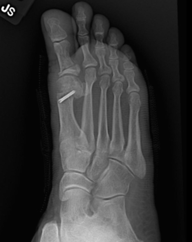 An x-ray showing a foot after bunion surgery