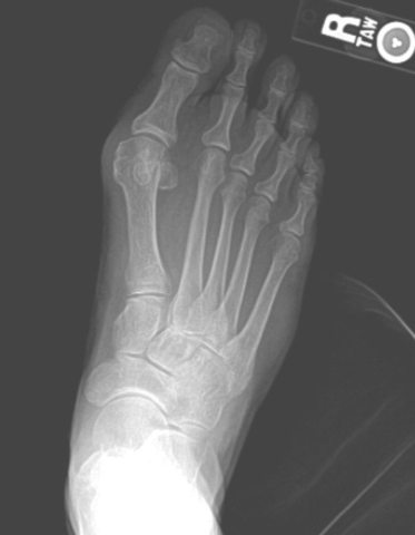 An x-ray showing a foot before bunion surgery